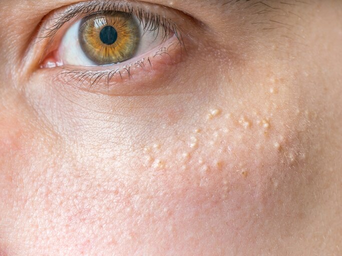 Frau mit Milien um die Augen | © Getty Images/vchal